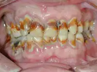 tobacco damage