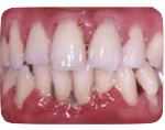 Periodontal Disease and the link to Diabetes