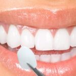 Instant Orthodontics via Porcelain Veneers