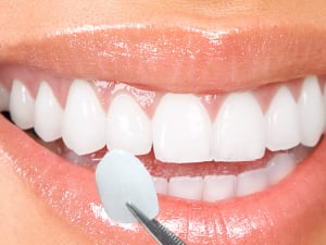 Dental Veneers