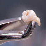 Wisdom Teeth, Invisalign & Braces