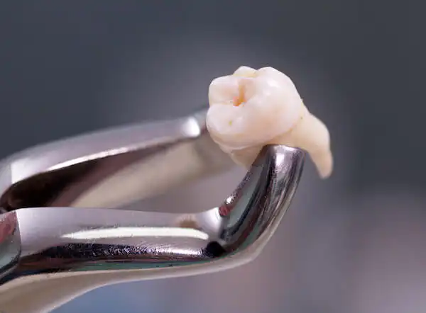 Wisdom Teeth Extraction