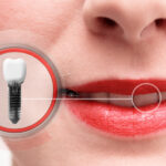 The Ins and Outs of Dental Implants