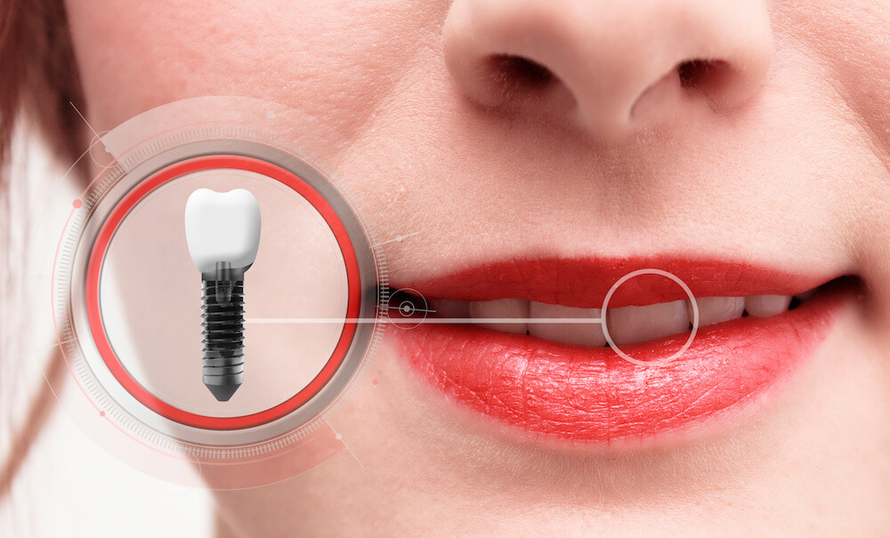 The Ins and Outs of Dental Implants