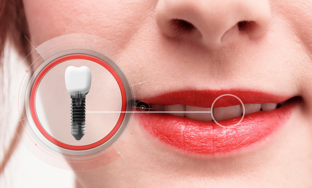 dental implant