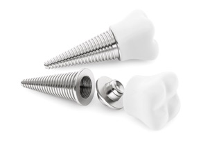 Dental Implants in Covina
