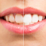 Don’t DIY Your Smile: Why You Need Professional Teeth Whitening
