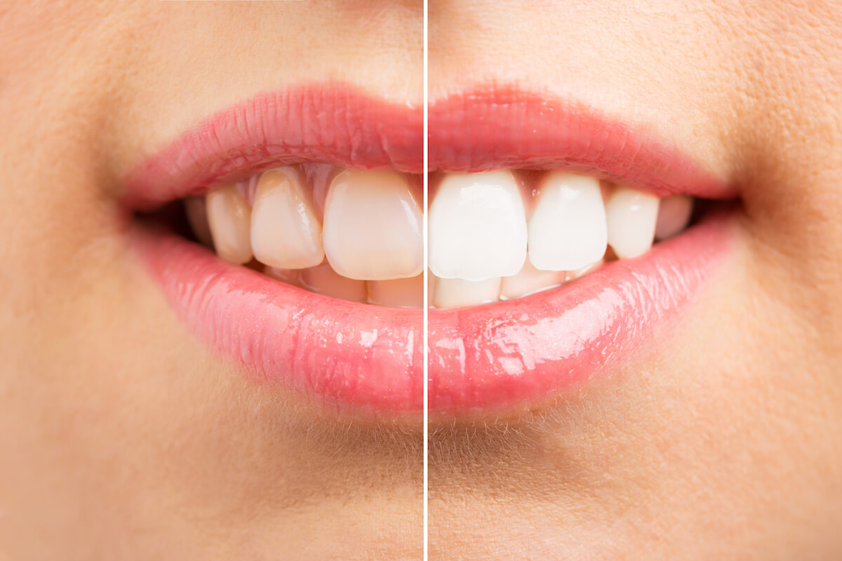 Don’t DIY Your Smile: Why You Need Professional Teeth Whitening