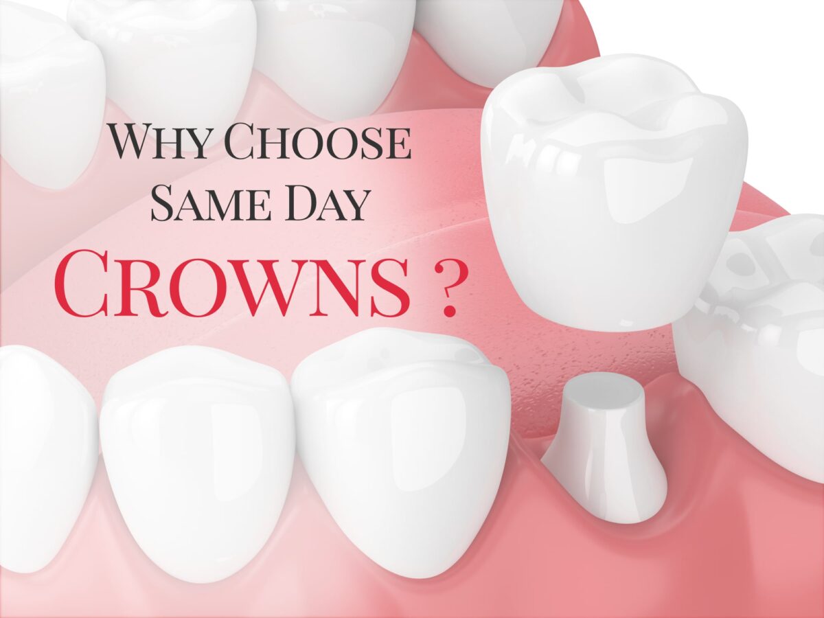 Why choose same day crowns