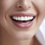 Composite Veneers vs Porcelain Veneers: Which Is the Best Choice For You?
