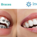 Invisalign vs Braces: Which Choice is Right for You?