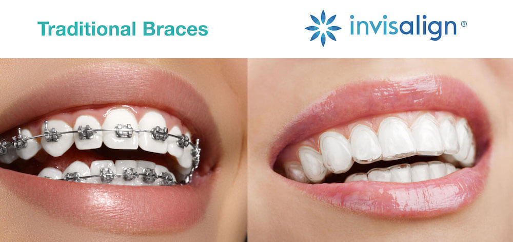 braces vs Invisalign