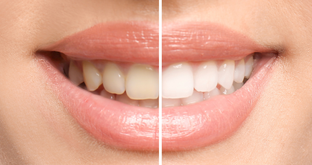 before/after of veneers