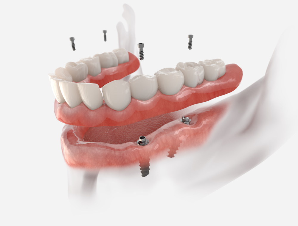 fixed denture model