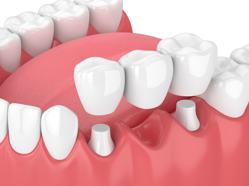 dental bridge model