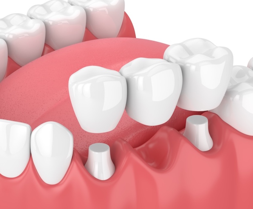 dental bridge model