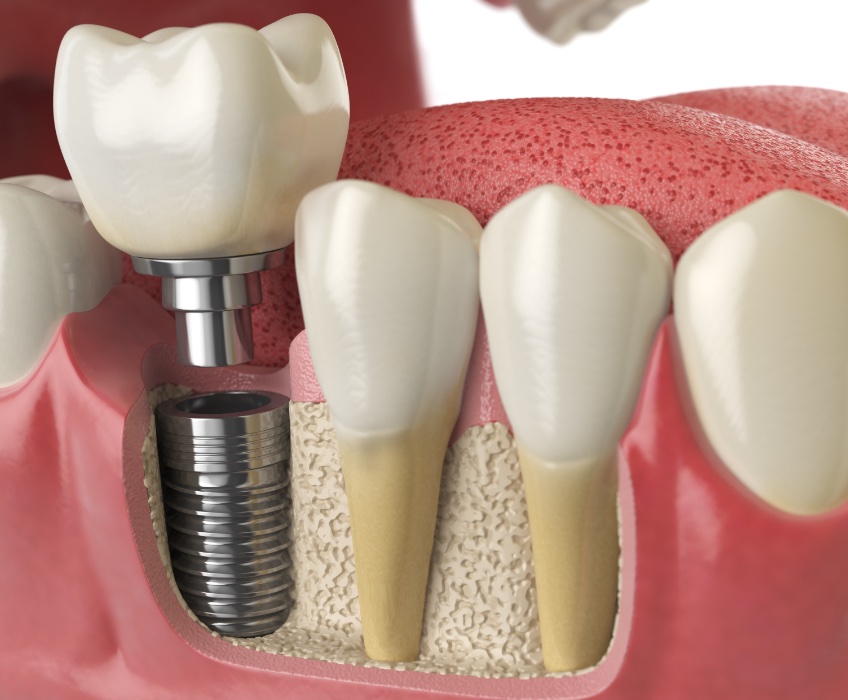 dental implant model