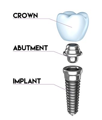 dental implant illustration