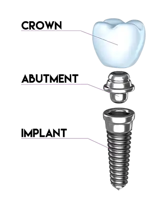 dental implant illustration